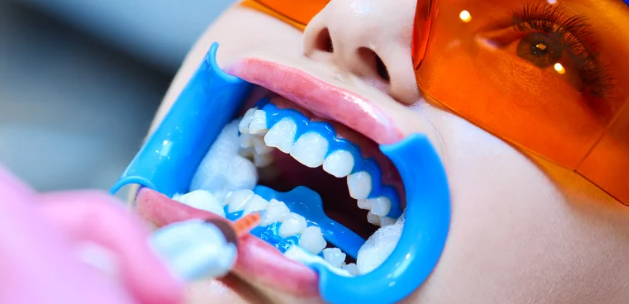 Blanqueamiento Consultorio