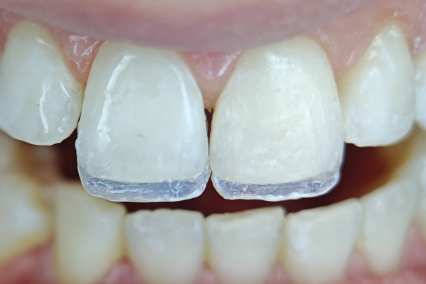 Detalle Carillas Resina 2