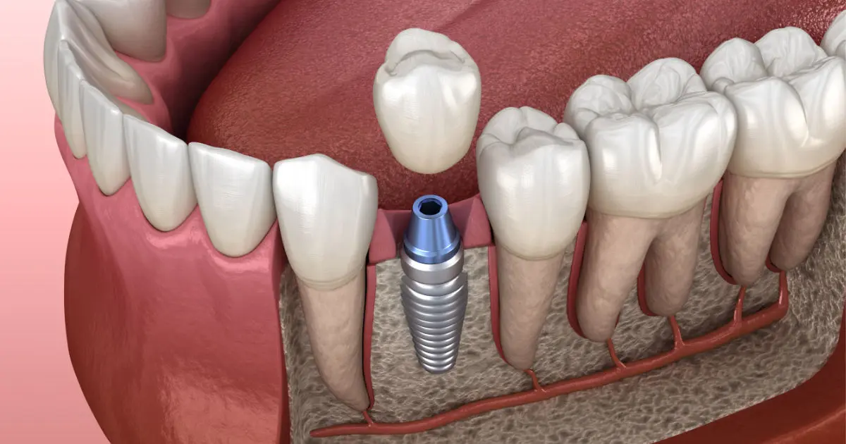 Especialista en Implantes Dentales
