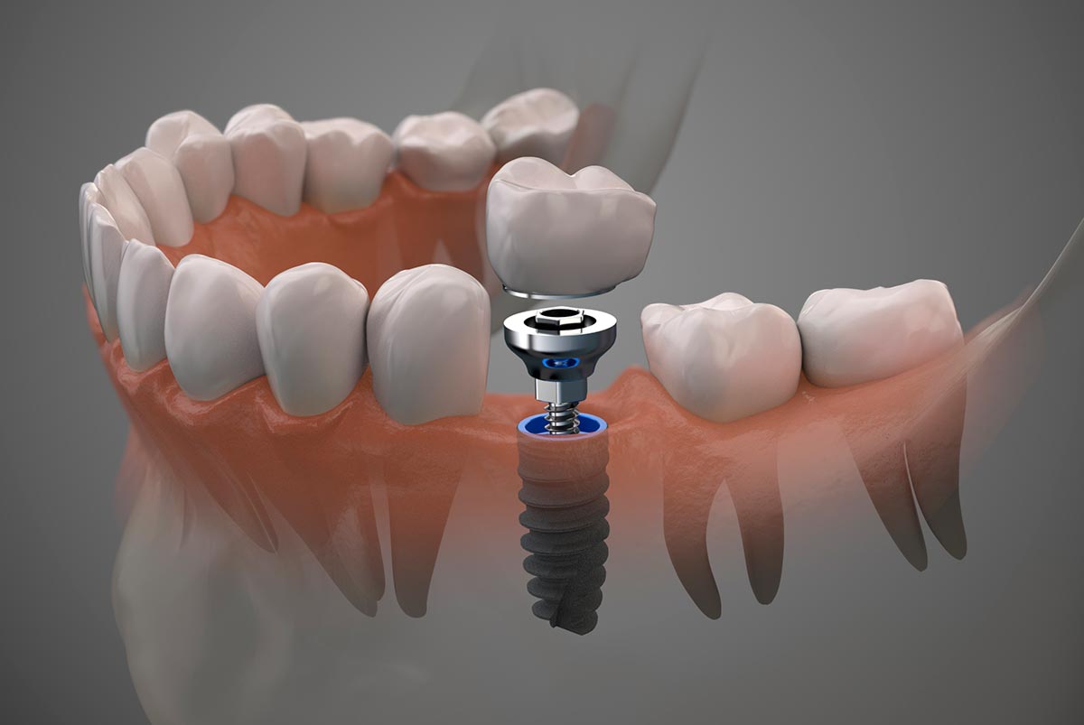 Implantes dentales