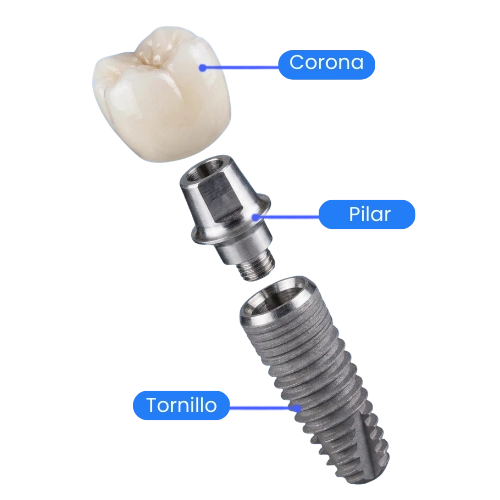 Infografía explicativa de las partes de un implante dental: Implante, pilar y corona de porcelana